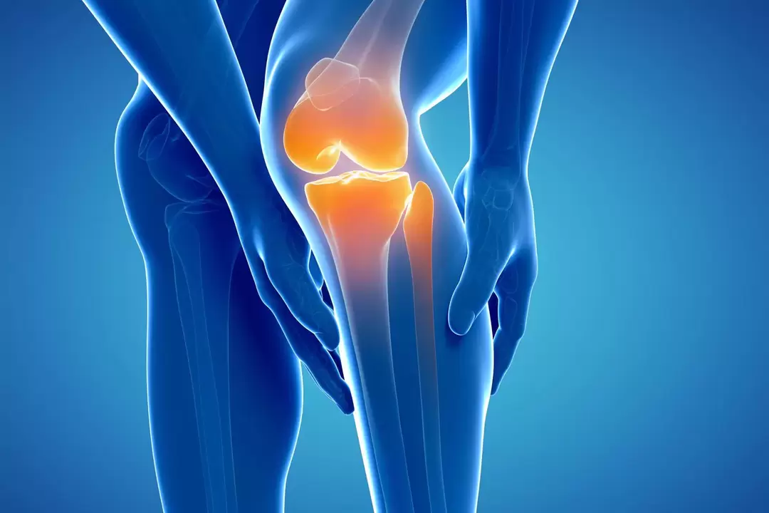 Arthrosis of the knee joint (gonarthrosis, deforming osteoarthritis)