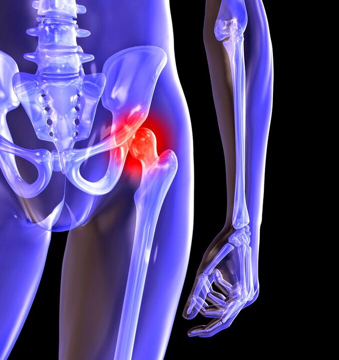 Deforming arthrosis of the hip joint