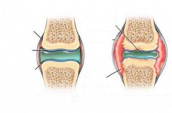 The process of deformation of the joint