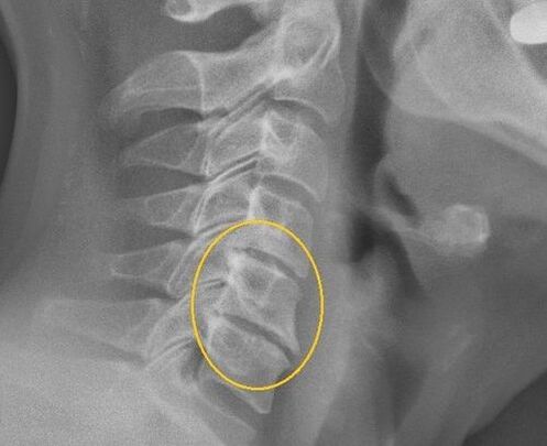 Osteochondrosis of the cervical spine on an X -ray