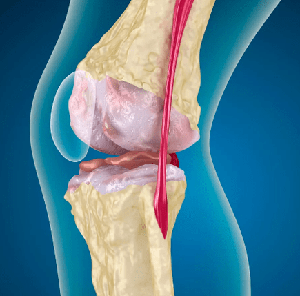 Arthrososis of the knee joint
