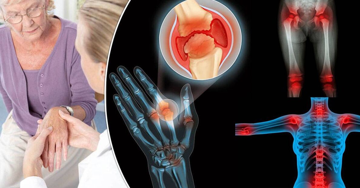 what is arthrosis